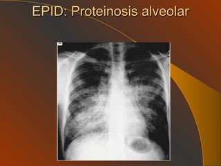 EPID: Proteinosis alveolar 