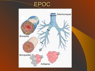 EPOC 
