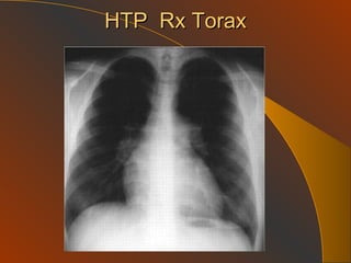 HTP  Rx Torax 