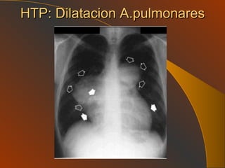 HTP: Dilatacion A.pulmonares 