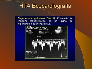 HTA Ecocardiografía 