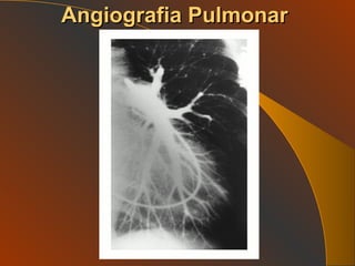 Angiografia Pulmonar 