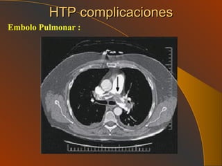 HTP complicaciones Embolo Pulmonar : 