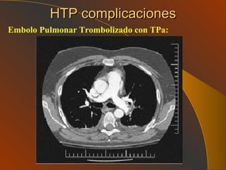 HTP complicaciones Embolo Pulmonar Trombolizado con TPa: 