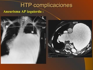 HTP complicaciones Aneurisma AP izquierda : 