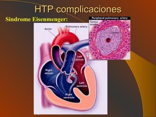 HTP complicaciones Sindrome Eisenmenger: 