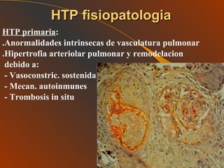 HTP primaria : .Anormalidades intrinsecas de vasculatura pulmonar  .Hipertrofia arteriolar pulmonar y remodelacion debido a:  - Vasoconstric. sostenida - Mecan. autoinmunes - Trombosis in situ HTP fisiopatologia 
