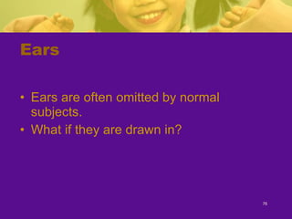 Ears Ears are often omitted by normal subjects. What if they are drawn in? 
