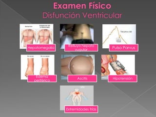 Refluyo hepato
Hepatomegalia
                     yugular
                                     Pulso Parvus




    Edema
                      Ascitis        Hipotensión
   periférico




                Extremidades frías
 