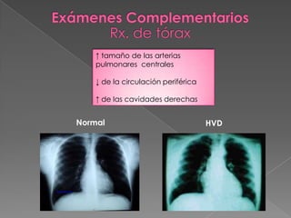 ↑ tamaño de las arterias
    pulmonares centrales

    ↓ de la circulación periférica

    ↑ de las cavidades derechas


Normal                               HVD
 