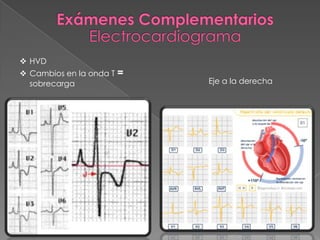 HVD
 Cambios en la onda T =
  sobrecarga               Eje a la derecha
 