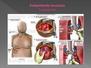 Hipertension pulmonar