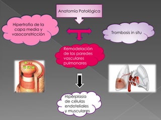 Anatomía Patológica


Hipertrofia de la
 capa media y
vasoconstricción                          Trombosis in situ



                      Remodelación
                      de las paredes
                      vasculares
                      pulmonares




                      Hiperplasia
                      de células
                      endoteliales
                      y musculares
 
