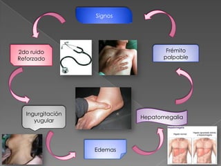 Signos




2do ruido                          Frémito
Reforzado                         palpable




  Ingurgitación
                           Hepatomegalia
     yugular




                  Edemas
 