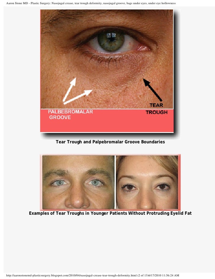 Treatment of nasojugal crease or tear trough deformity.