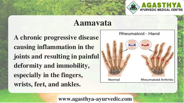 Ayurvedic Treatment For Arthritis In Kochi | Best 