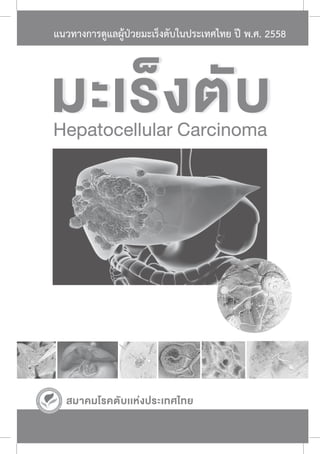 สมาคมโรคตับเเหงประเทศไทย
มะเร็งตับ
Hepatocellular Carcinoma
แนวทางการดูแลผูปวยมะเร็งตับในประเทศไทย ป พ.ศ. 2558
 
