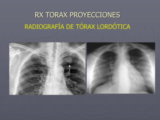RADIOGRAFÍA DE TÓRAX LORDÓTICA
RX TORAX PROYECCIONES
 