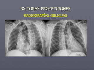 RADIOGRAFÍAS OBLICUAS
RX TORAX PROYECCIONES
 