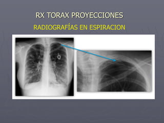 RADIOGRAFÍAS EN ESPIRACION
RX TORAX PROYECCIONES
 
