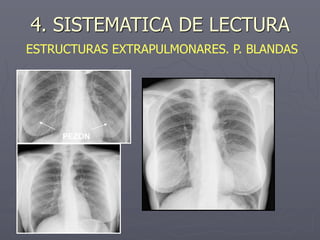 4. SISTEMATICA DE LECTURA
ESTRUCTURAS EXTRAPULMONARES. P. BLANDAS
PEZON
 