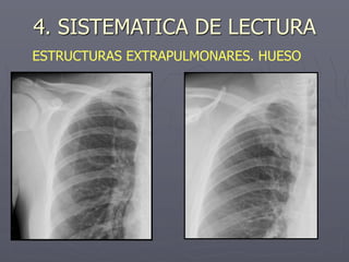 4. SISTEMATICA DE LECTURA
ESTRUCTURAS EXTRAPULMONARES. HUESO
 