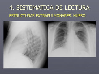 4. SISTEMATICA DE LECTURA
ESTRUCTURAS EXTRAPULMONARES. HUESO
 
