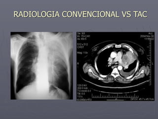 RADIOLOGIA CONVENCIONAL VS TAC
 