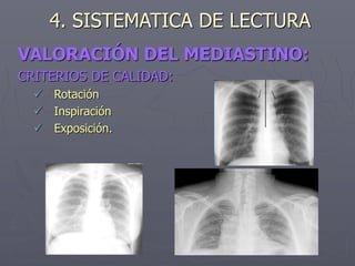 VALORACIÓN DEL MEDIASTINO:
CRITERIOS DE CALIDAD:
 Rotación
 Inspiración
 Exposición.
4. SISTEMATICA DE LECTURA
 