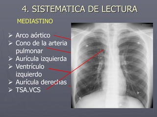  Arco aórtico
 Cono de la arteria
pulmonar
 Aurícula izquierda
 Ventrículo
izquierdo
 Aurícula derechas
 TSA.VCS
4. SISTEMATICA DE LECTURA
MEDIASTINO
 