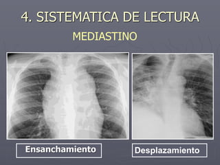Desplazamiento
Ensanchamiento
4. SISTEMATICA DE LECTURA
MEDIASTINO
 