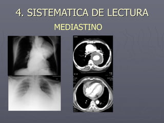 4. SISTEMATICA DE LECTURA
MEDIASTINO
 