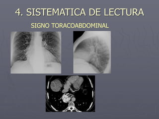 4. SISTEMATICA DE LECTURA
SIGNO TORACOABDOMINAL
 