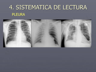 4. SISTEMATICA DE LECTURA
PLEURA
 