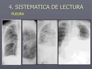 4. SISTEMATICA DE LECTURA
PLEURA
 