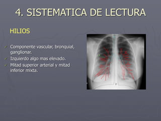 4. SISTEMATICA DE LECTURA
 Componente vascular, bronquial,
ganglionar.
 Izquierdo algo mas elevado.
 Mitad superior arterial y mitad
inferior mixta.
HILIOS
 