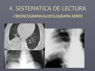 BRONCOGRAMA/ALVEOLOGRAMA AEREO
4. SISTEMATICA DE LECTURA
 