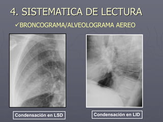 Condensación en LSD Condensación en LID
4. SISTEMATICA DE LECTURA
BRONCOGRAMA/ALVEOLOGRAMA AEREO
 