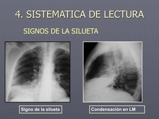 Signo de la silueta Condensación en LM
4. SISTEMATICA DE LECTURA
SIGNOS DE LA SILUETA
 
