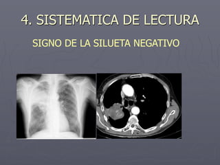 4. SISTEMATICA DE LECTURA
SIGNO DE LA SILUETA NEGATIVO
 