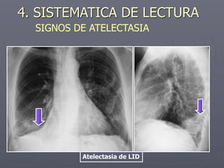 Atelectasia de LID
4. SISTEMATICA DE LECTURA
SIGNOS DE ATELECTASIA
 
