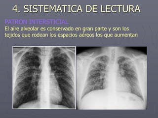 4. SISTEMATICA DE LECTURA
PATRON INTERSTICIAL
El aire alveolar es conservado en gran parte y son los
tejidos que rodean los espacios aéreos los que aumentan
 