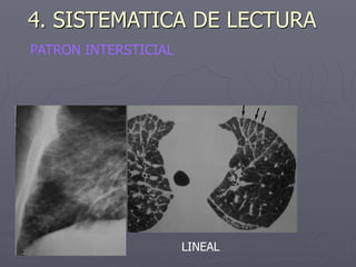 PATRON INTERSTICIAL
LINEAL
4. SISTEMATICA DE LECTURA
 
