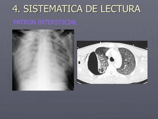PATRON INTERSTICIAL
4. SISTEMATICA DE LECTURA
 