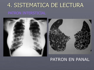 PATRON EN PANAL
PATRON INTERSTICIAL
4. SISTEMATICA DE LECTURA
 