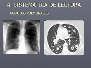 4. SISTEMATICA DE LECTURA
NODULOS PULMONARES
 
