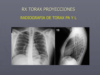 RX TORAX PROYECCIONES
RADIOGRAFIA DE TORAX PA Y L
 