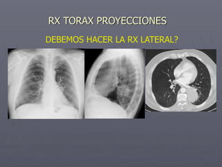 RX TORAX PROYECCIONES
DEBEMOS HACER LA RX LATERAL?
 