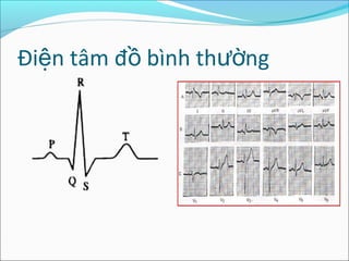 Điện tâm đồ bình thường
 