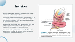 Lahey Incision Tecnica Quirúrgica Histerectomia Vaginal.pdf